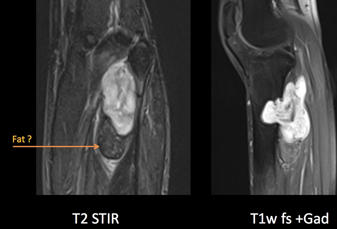 Figure 3 for case Dedifferentiated liposarcoma ( RID4360 )